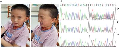 A de novo DDX3X Variant Is Associated With Syndromic Intellectual Disability: Case Report and Literature Review